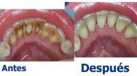 /album/dental-solutions/tratamientos-limpieza-ultrasonica-jpg/